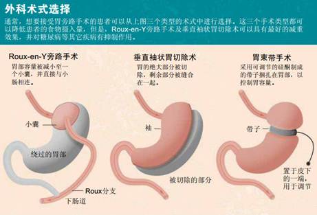 Nature:减重手术的术式选择难题